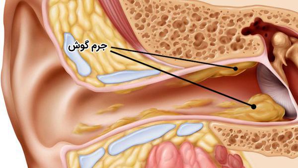 جرم گوش کاهش شنوایی