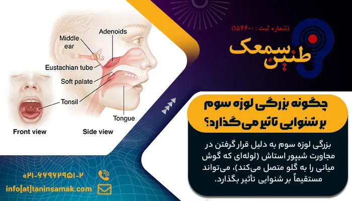 چگونه بزرگی لوزه سوم بر شنوایی تاثیر می‌گذارد؟